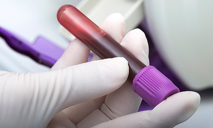 For the new blood test blood samples are taken from the patients and tested for two protein markers. (Image: Gab13 / istockphotos)