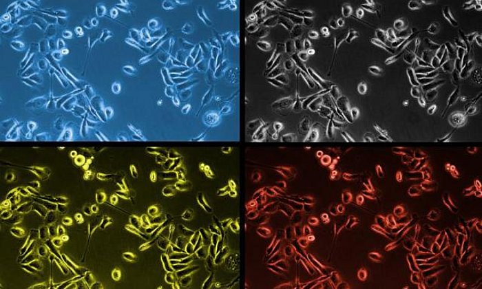 Eingefärbte Krebszellen der Prostata unter dem Mikroskop.