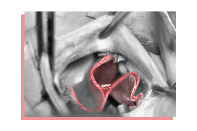 Minimally invasive cardiac surgical technique