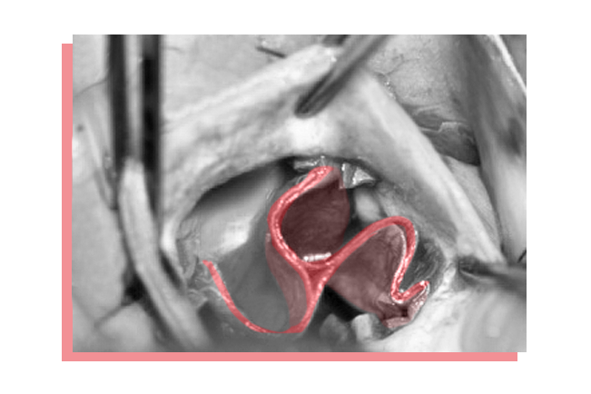 Minimalinvasive Operationsmethode am Herzen