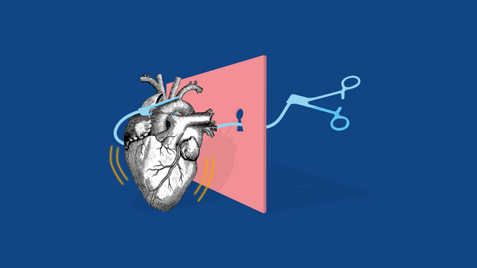 Illustrative image of minimally invasive heart surgery: an intrathoracic clamp accessing a heart through a keyhole