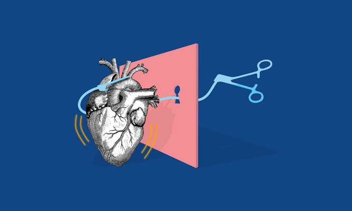 Illustrative image of minimally invasive heart surgery: an intrathoracic clamp accessing a heart through a keyhole