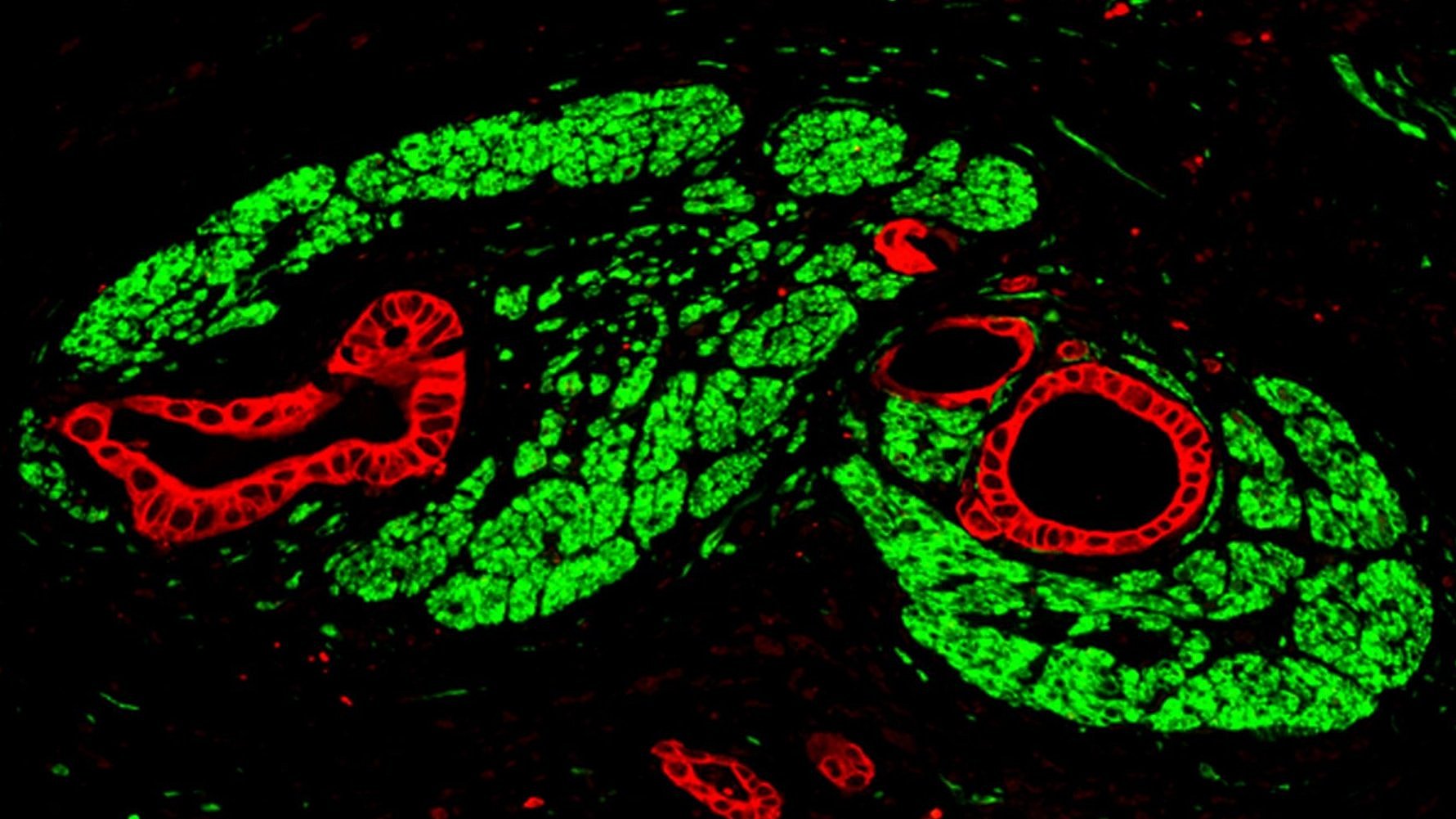  Immunofluoreszenz-Aufnahme von Bauchspeicheldrüsenkrebs