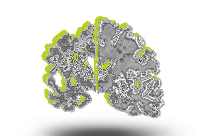 Brain with Alzheimer's disease shown as a graphic represenation