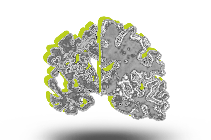 Gehirn mit Alzheimer als grafische Darstellung