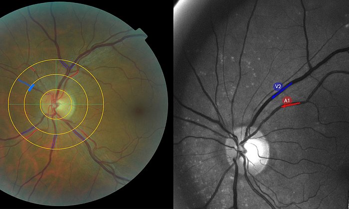 Zwei Aufnahmen aus Augenuntersuchungen
