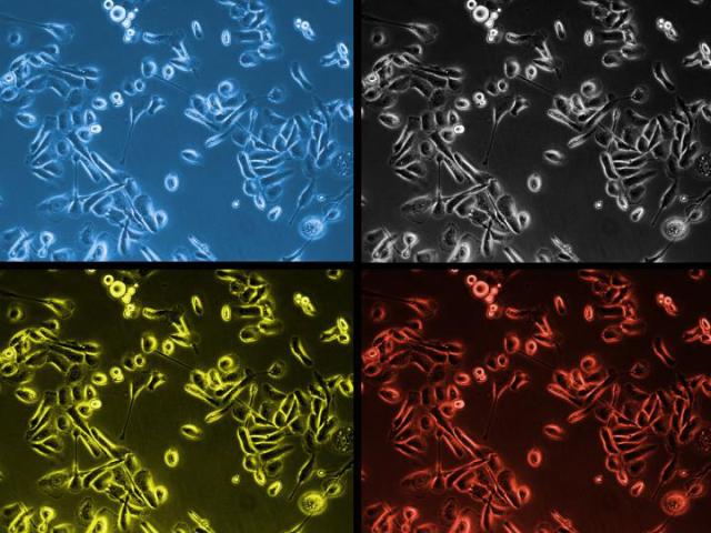 Eingefärbte Krebszellen der Prostata unter dem Mikroskop.